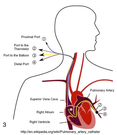 swan-ganz catheter | Pulmonary Artery Catheterization (Swan-Ganz ...