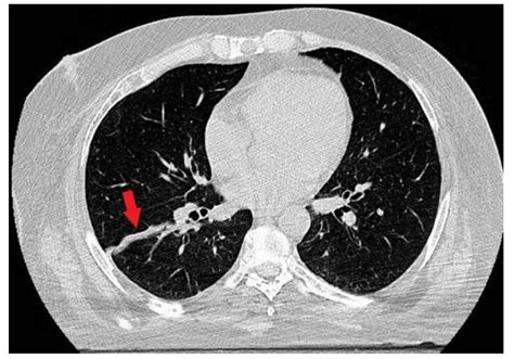 Thoracic CT Scan Findings in Patients with Confirmed Hematologic ...