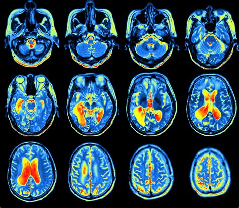 FDG PET Scan More Accurately Assesses Alzheimer's Cognitive Decline