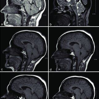 Progression of the cerebellar ectopia. e patient's symptoms began in ...