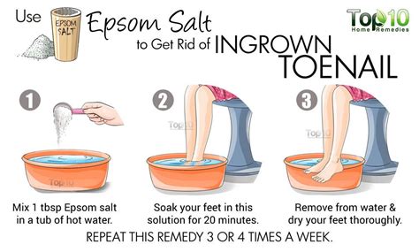 How To Treat Ingrown Toenail At Home Without Effort - Fitneass