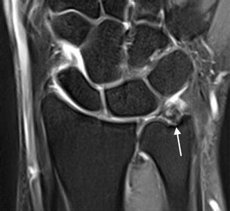 Coronal T2-weighted wrist MRI showing a TFCC tear (arrow) | Download ...