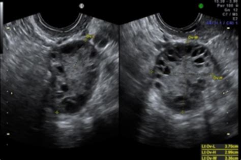 SINDROME DE OVARIOS POLIQUÍSTICOS - Centro de Diagnóstico por Imágenes ...