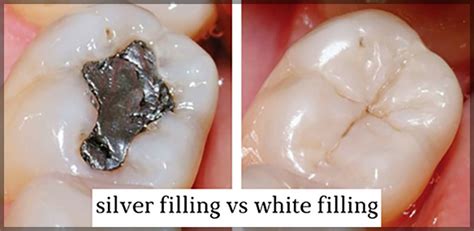 White Fillings | White Composite Filling | Ottawa Dentist