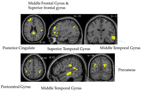 Postcentral Gyrus Mri