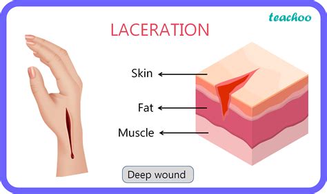 [Term 2 Sample Paper] What is Laceration and how can it be managed?