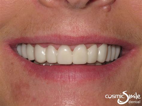 Snap on Smile Before and After - Cosmic Smile Dental