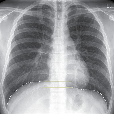 Normal Chest X Ray Labeled