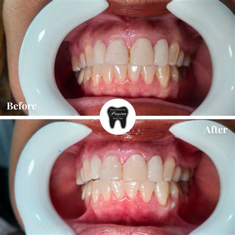 Bleaching Gigi Bandung - Passion Dental Care