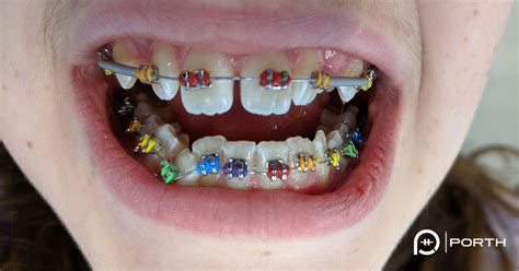 Colored Braces | Modern Orthodontics Clinic