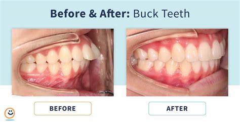 Braces: Before and After Buck Teeth