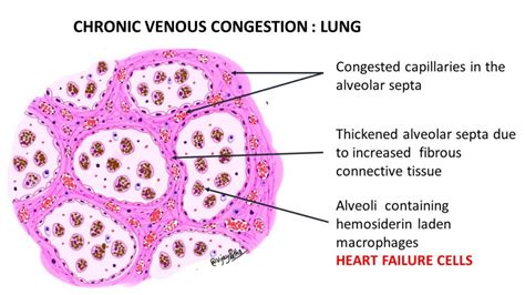 CHRONIC VENOUS CONGESTION – LUNG - Pathology Made Simple