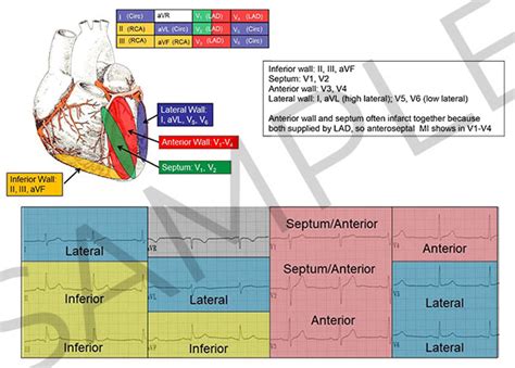 12 Lead ECG Reference Chart (Printed) – Cardiovascular Nursing ...