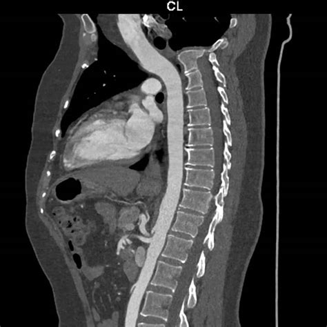 CT Scan Lumbar Spine - Diagnostic Imaging - Melbourne Radiology