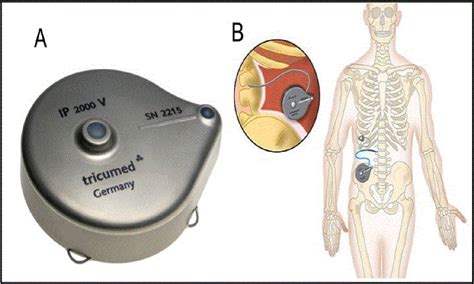 Figure 1 from Intrathecal Morphine Therapy for Chronic Non-malignant ...