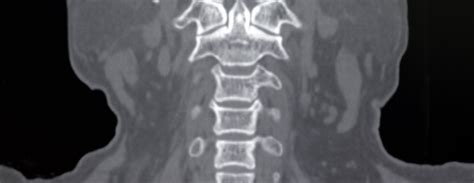 Cervical Spine Anatomy Ct Scan