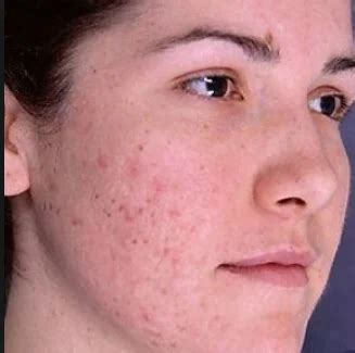 Acne & Pimple Marks Treatment at best price in Jaipur | ID: 8826502297