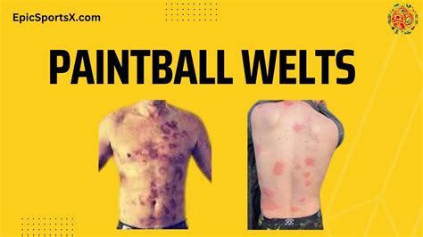 Paintball Welts - EpicSportsX - Best Sports Blogs