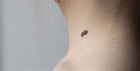 Warts Causes and Treatment | SILKOR UAE