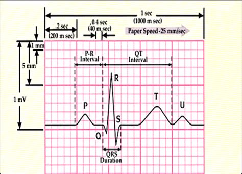 How to read an ECG – Physical Therapy Reviewer