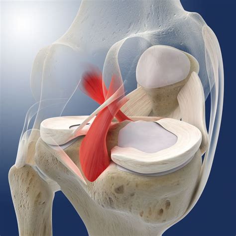 Posterior Cruciate Ligament Tears and Treatment