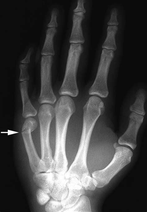 Hand Fractures – Surgically Dr. George Morrison