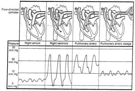 Haemodynamic monitoring: Swan Ganz Wave Forms | ICU | Pinterest | Swans ...