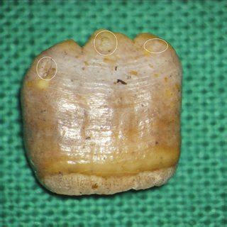 Lower mulberry molars with marked hypoplastic areas | Download ...