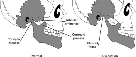 Physio for Jaw Dislocation | Pivotal Motion Physiotherapy