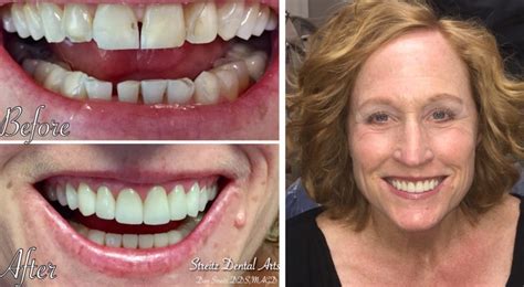 Before and After Photos of Dental Implants and Cosmetic Dentistry