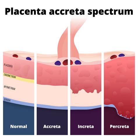 Placenta Accreta Spectrum Disorder | Hot Sex Picture