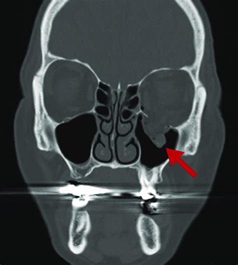 Orbital Floor Fracture Surgery Plications - Carpet Vidalondon