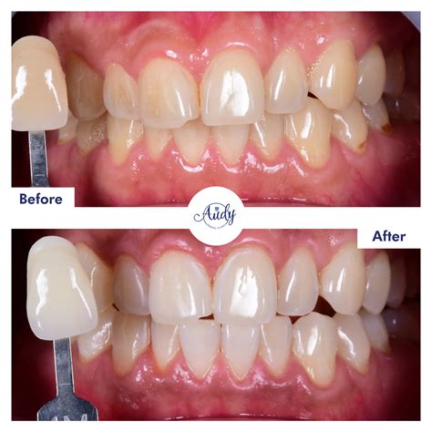 New 15-03 | Audy Dental