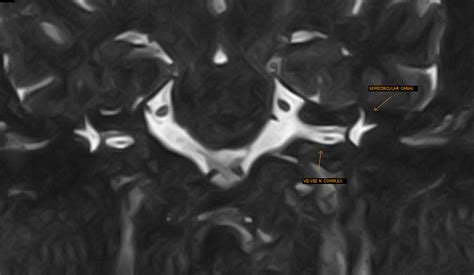 Membranous Labyrinth MRI - Sumer's Radiology Blog