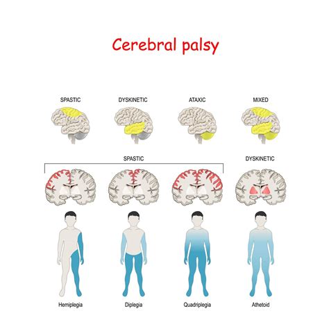 What is Cerebral Palsy? - Premier Neurology & Wellness Center