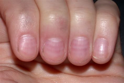 Nail changes - wikidoc