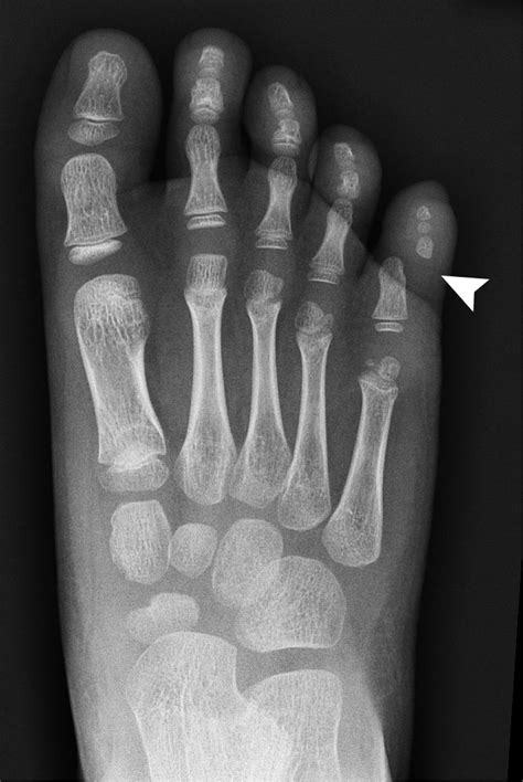 Post-traumatic toe deformity in a child | The BMJ