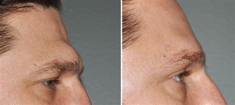 Concepts in Male Brow Bone Reduction - Explore Plastic Surgery