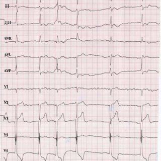 ECG showing atrial fibrillation and LVH and a gross increase in ...