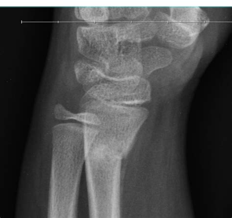 Torus fracture – Radiology Cases