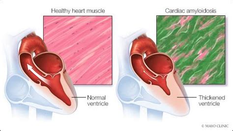 Mayo Clinic Q&A podcast: Successful treatment of cardiac amyloidosis ...