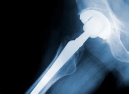 DePuy Pinnacle Hip Replacement Lawsuit News & Legal Information