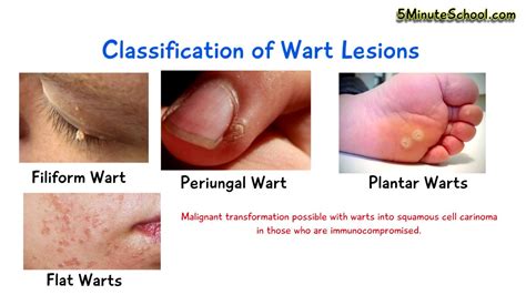 Viral Warts Symptoms