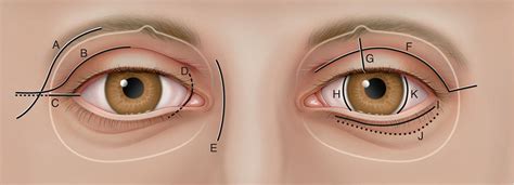 Orbital Surgery | Ento Key