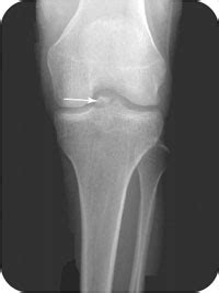 Tibial Spine Fracture Radiology