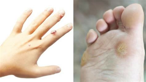 Viral Warts: Causes, Treatment and Home Remedy – Vitamin Resource