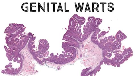 Genital Wart