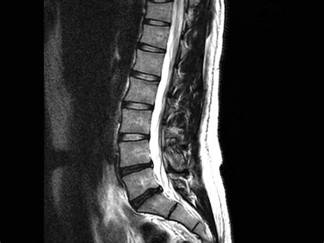 Back Pain and Normal MRI, is it possible?: Advanced Pain Management ...