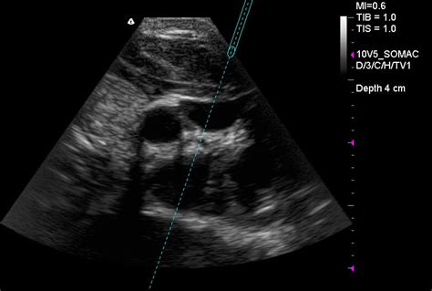 Novel Ultrasound Guidance System for Real-time Central Venous ...