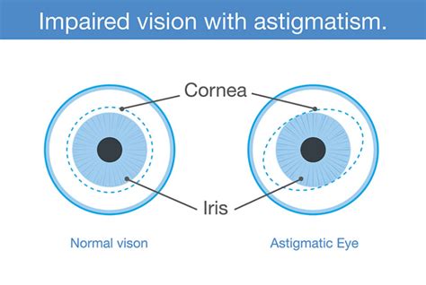 Astigmatism Q&A - Symptoms, Causes, Treatment